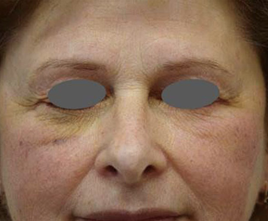 Arpès l'utilisation d'icoone post chirurgie