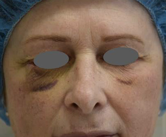 Avant l'utilisation d'icoone post chirurgie